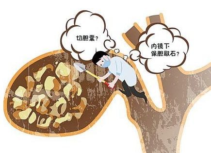 胆囊结石的治疗方法有哪些