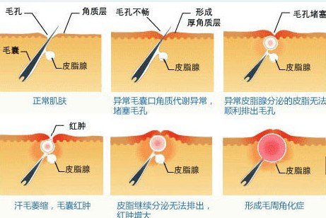 如何诊断毛角周化